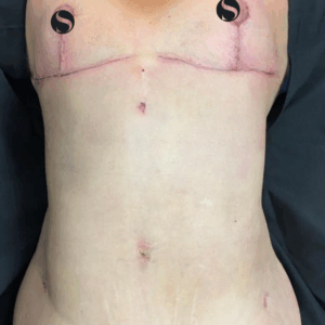 Breast Reduction with Implant Removal – 30094