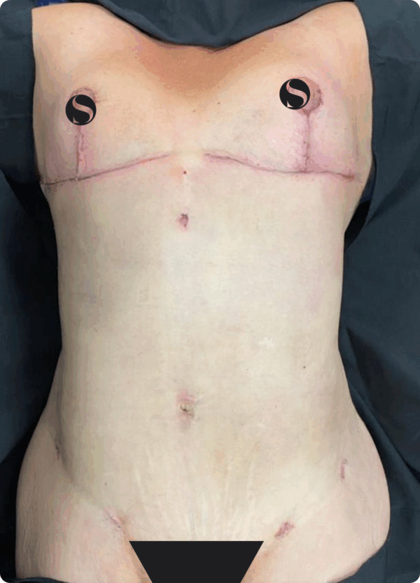 Breast Reduction with Implant Removal - 30094 - Image 2