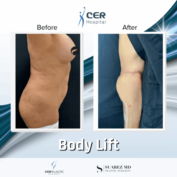 Body Lift - 2104 - Image 5