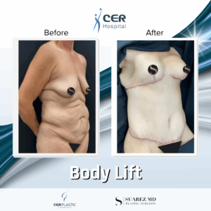 Body Lift – 9104