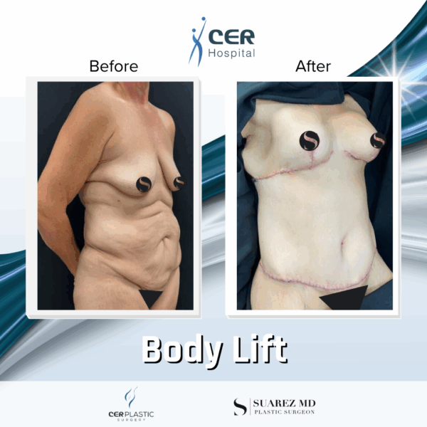 Body Lift - 9104