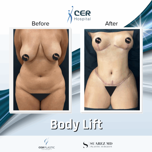 Body Lift - 20084 - Image 5