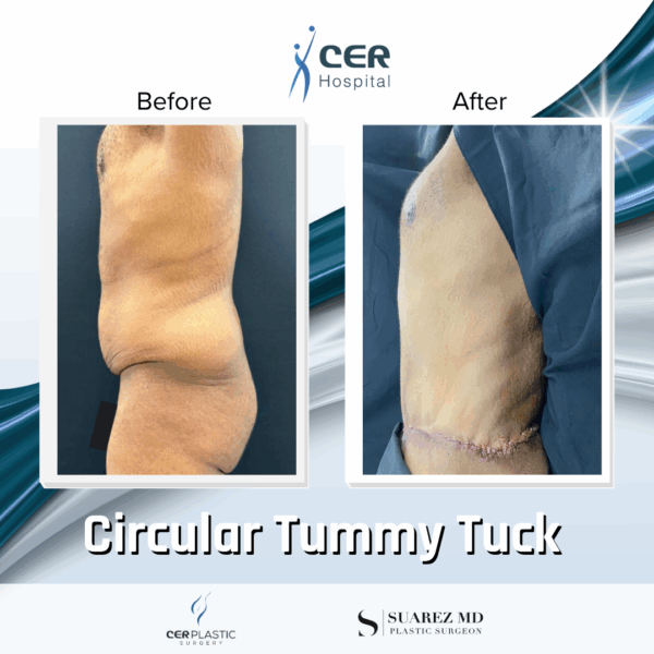 Circular Tummy Tuck - 11104 - Image 5