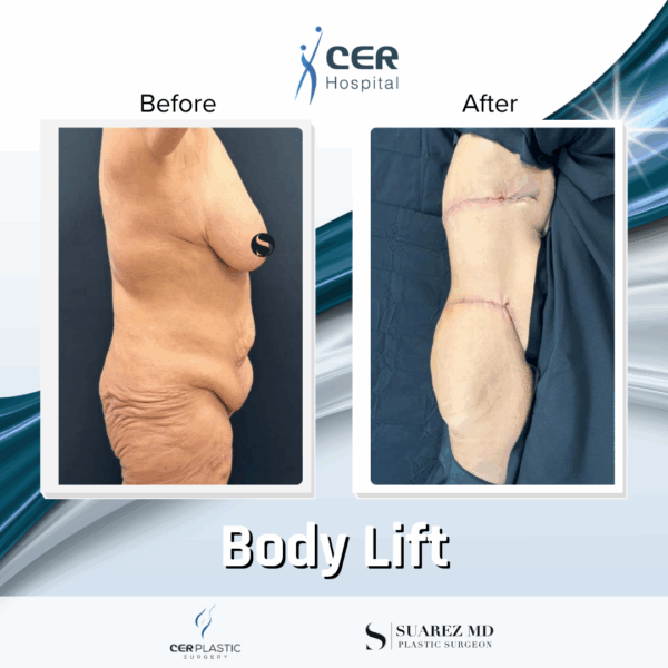 Body Lift - 0608 - Image 4
