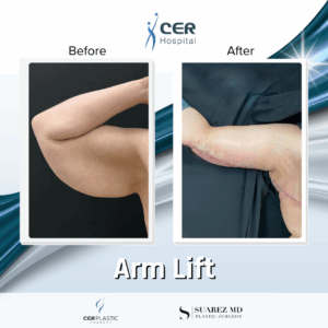 Arm Lift – 24074