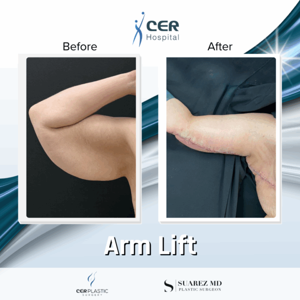 Arm Lift - 24074
