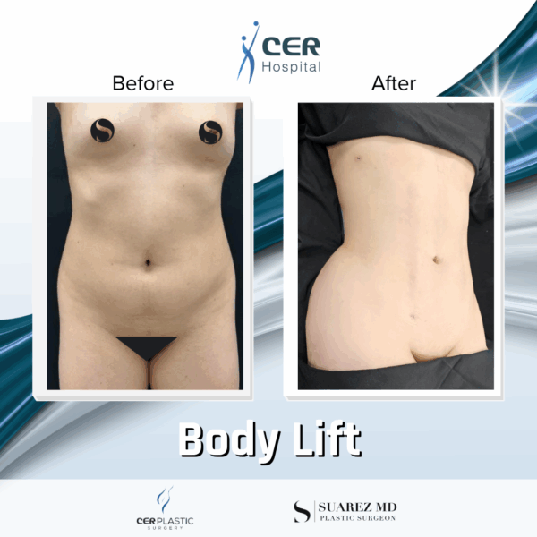 Body Lift - 22054 - Image 4