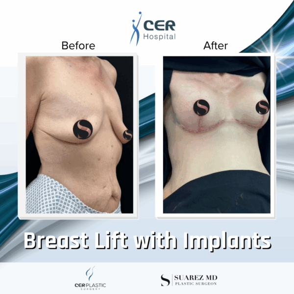 Breast Lift with Implants - 24054 - Image 5