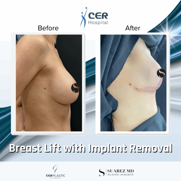 Breast Lift with Implant Removal - 14104 - Image 5