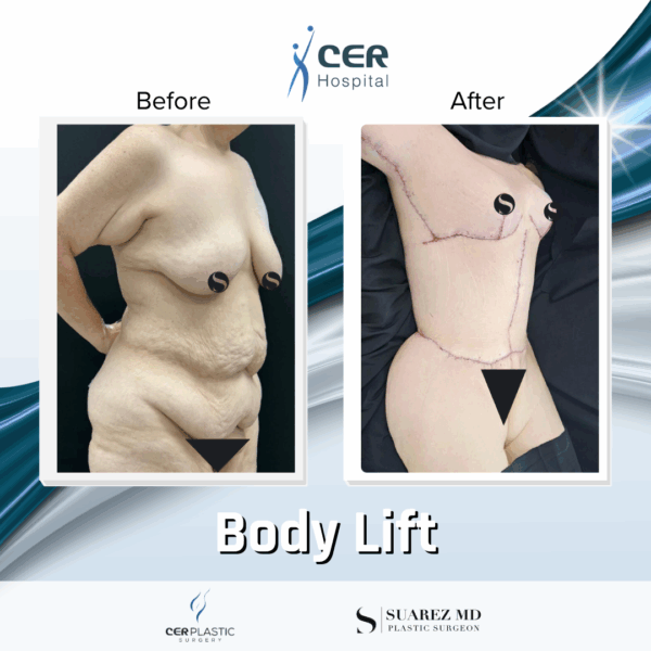 Body Lift - 24104 - Image 5