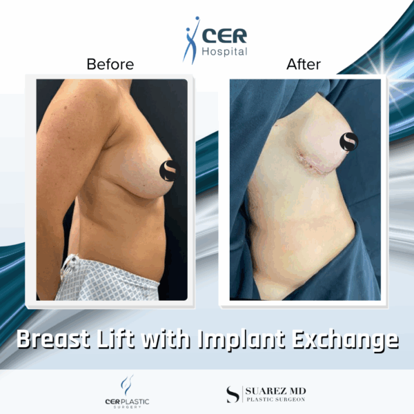 Breast Lift with Implant Exchange - 28104 - Image 5