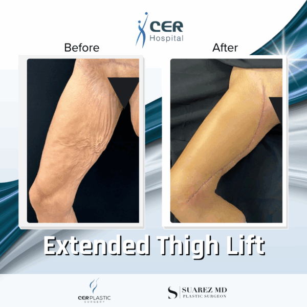Extended Thigh Lift - 30104 - Image 5