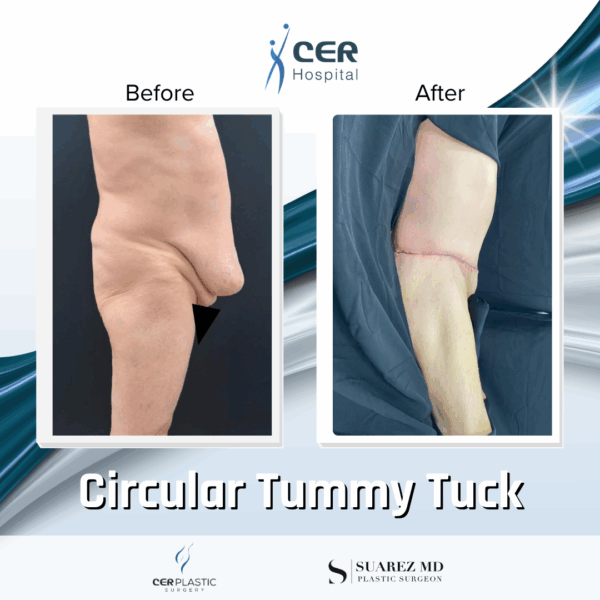 Circular Tummy Tuck - 11124 - Image 4
