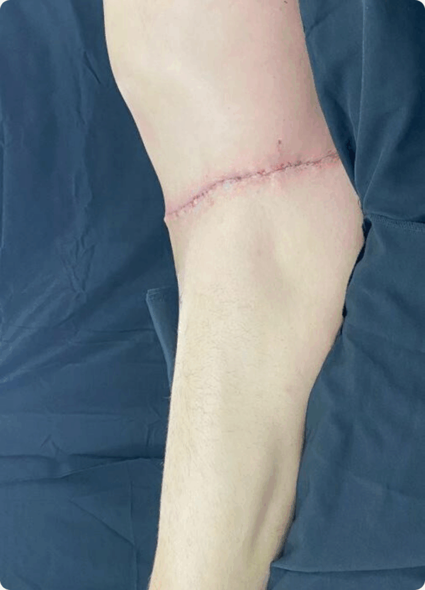Circular Tummy Tuck - 11124 - Image 2