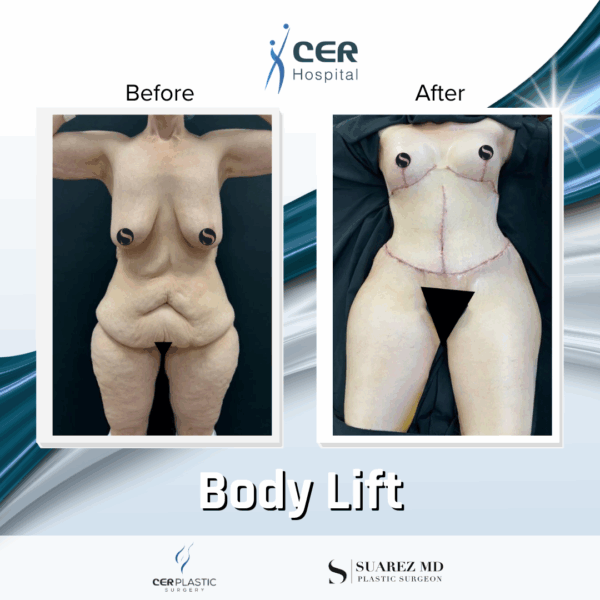 Body Lift - 18124 - Image 5