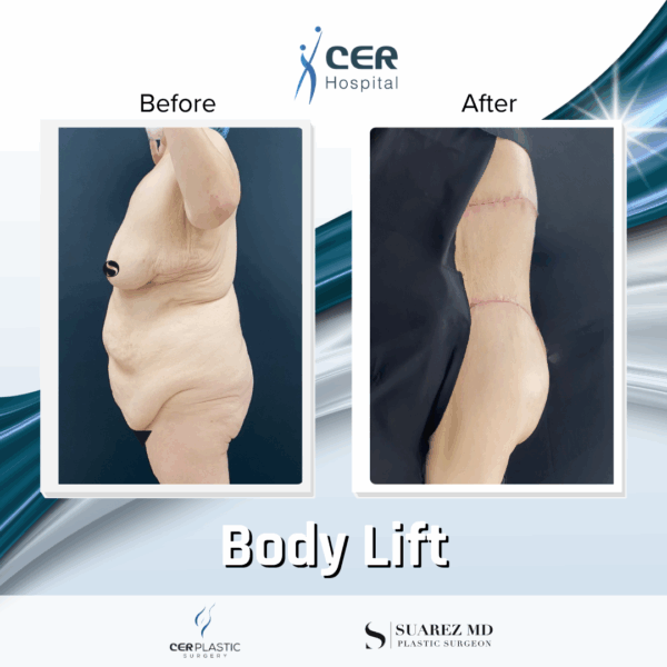 Body Lift - 7013 - Image 5