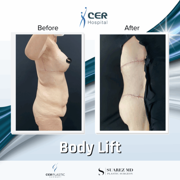 Body Lift - 8013 - Image 5
