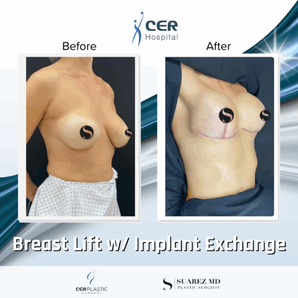 Breast Lift with Implant Exchange - 9013 - Image 5