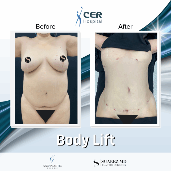 Body Lift - 11013