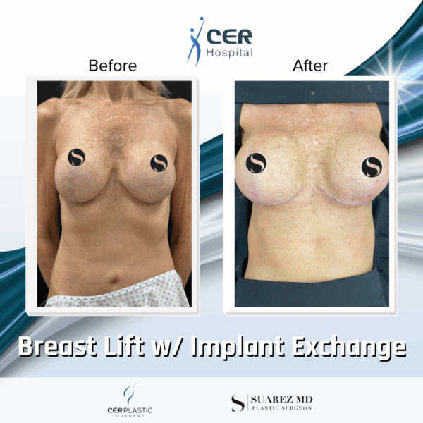 Breast Lift with Implants - 13013 - Image 5