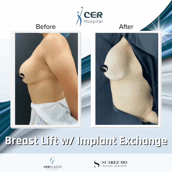 Breast Lift with Implant Exchange - 16013 - Image 4