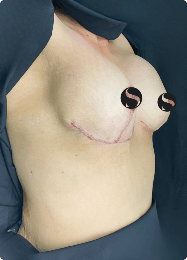 Breast Lift with Implant Exchange - 16013 - Image 2