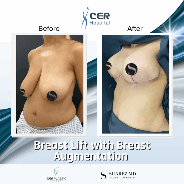 Breast Lift & Breast Augmentation - 16013 - Image 5