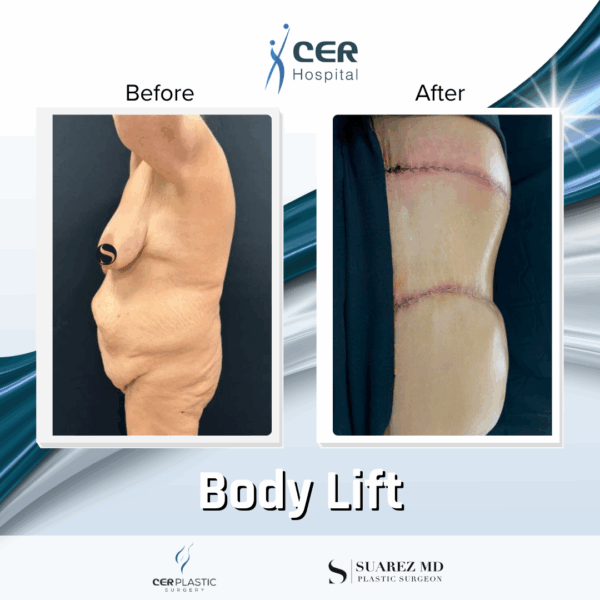 Body Lift - 31074 - Image 4