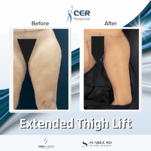 Extended Thigh Lift – 18013
