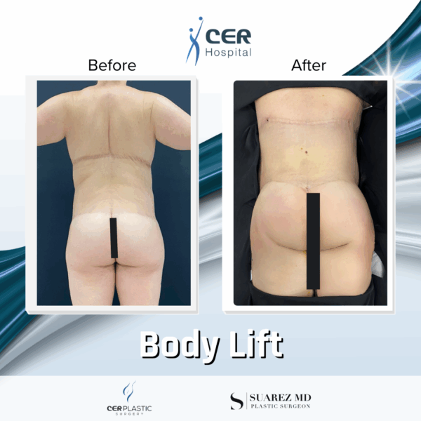 Body Lift - 20013 - Image 5