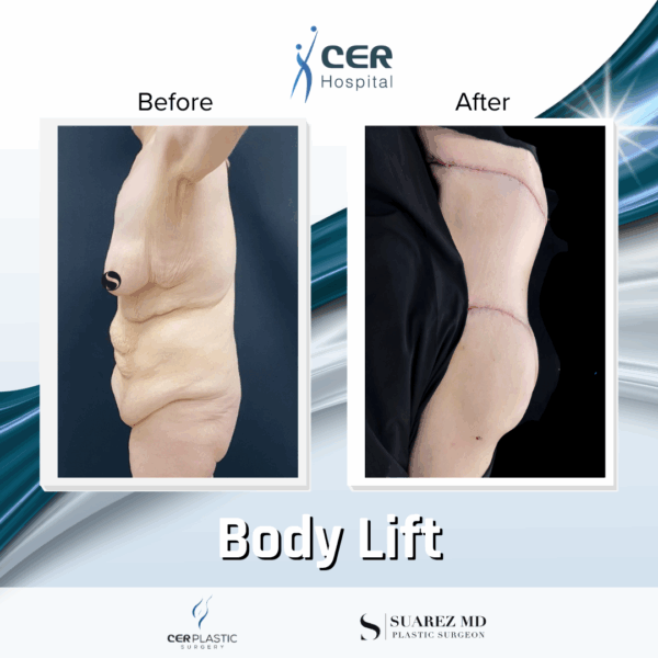 Body Lift - 20013 - Image 5