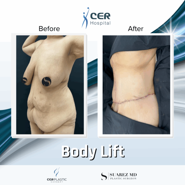 Body Lift - 23013 - Image 4