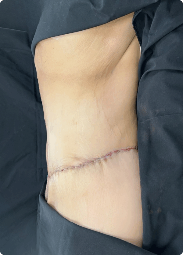 Body Lift - 23013 - Image 2