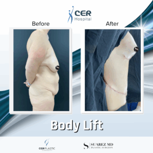 Body Lift – 13121