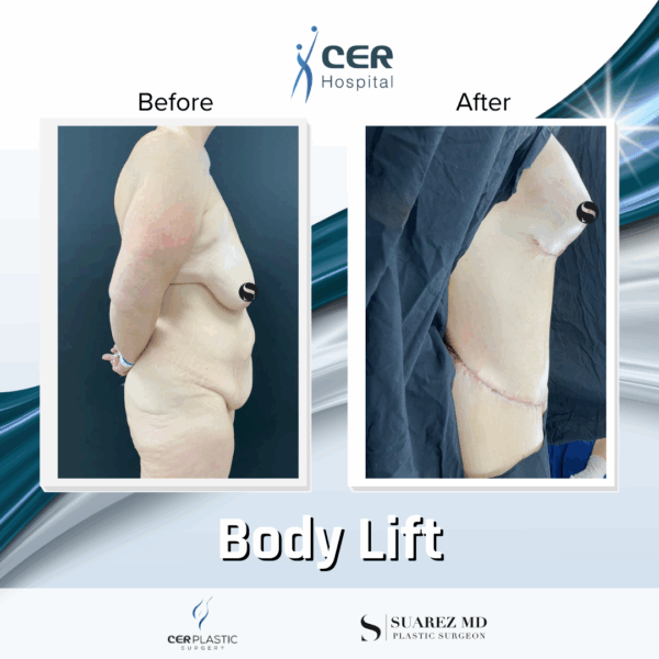Body Lift - 13121