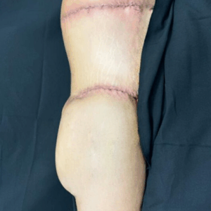 Body Lift – 31074