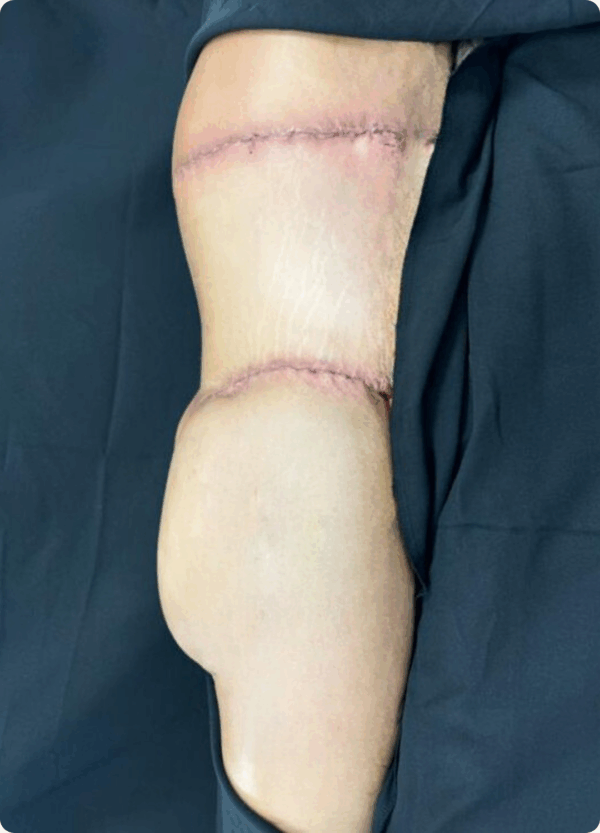 Body Lift - 31074 - Image 2