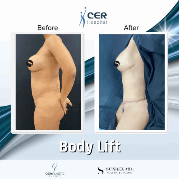 Body Lift - 26043 - Image 5