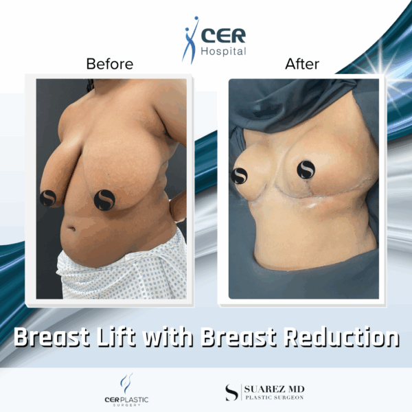 Breast Lift with Breast Reduction - 19043 - Image 4