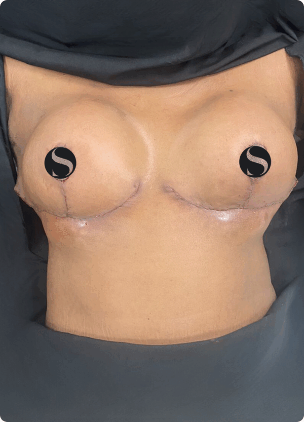 Breast Lift with Breast Reduction - 19043 - Image 2