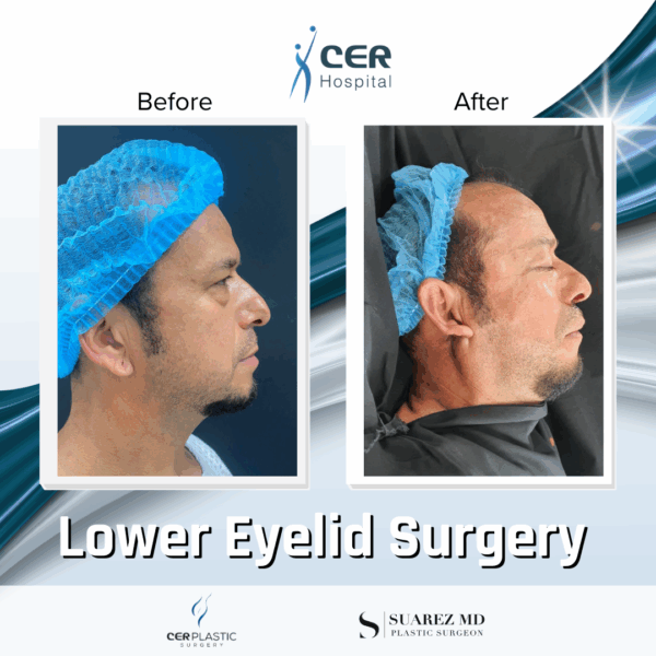 Lower Eyelid Surgery - 21043 - Image 5