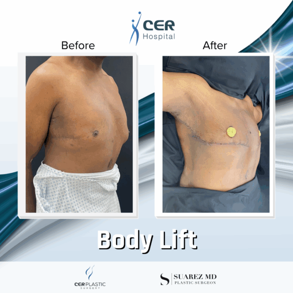 Body Lift - 19043 - Image 5