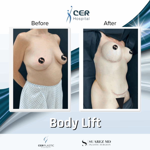 Body Lift - 5043 - Image 5