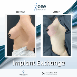 Breast Lift and Implant Exchange – 3043