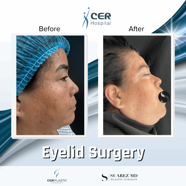 Eyelid Surgery - 5084