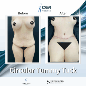 Circular Tummy Tuck – 3043