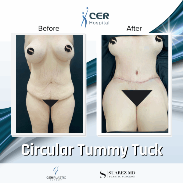 Circular Tummy Tuck - 3043