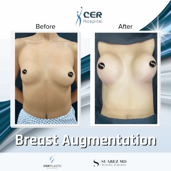 Breast Augmentation - 31053 - Image 5