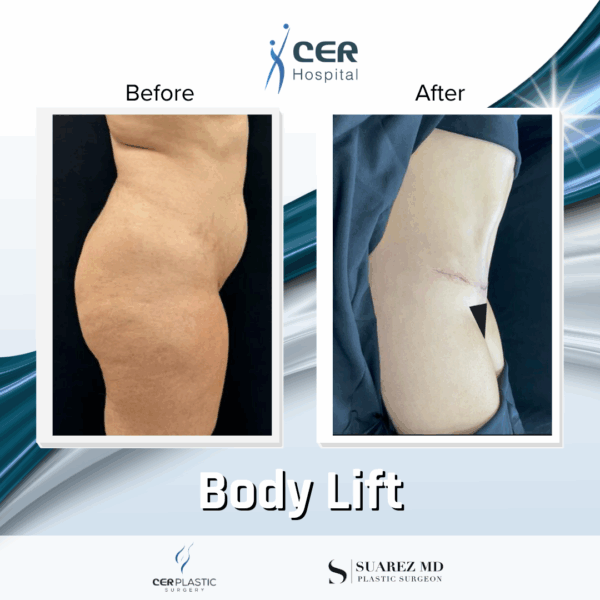 Body Lift - 16084