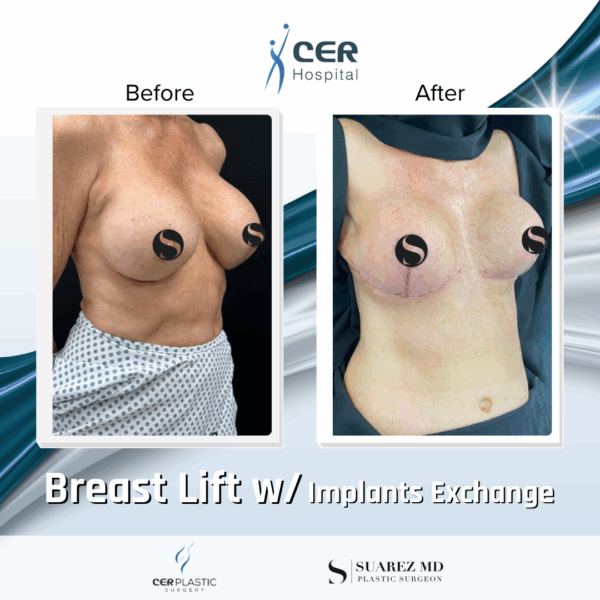 Breast Lift with Implant Exchange - 26084 - Image 5